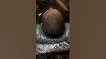 Trước và sau xăm hói tóc, khách hàng ngày hôm nay tại hà nội #reviewxămtóc