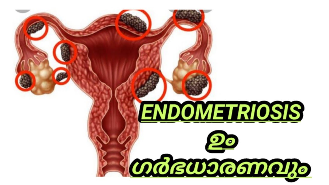 endometriosis malayalam//chocolate cyst//overian cyst//endometriosis pregnancy parustastebuds