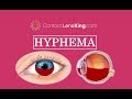 What is a hyphema blood pooling in the front of eye