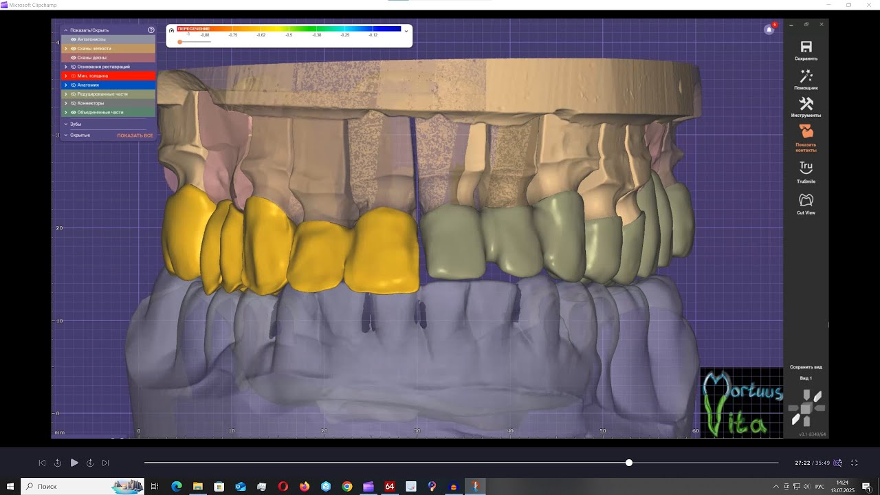 EXOCAD ДЛЯ ЧАЙНИКОВ 2 МОСТЫ #dentist #exocad #dentalcaddesign #3d #dentistry #crown #stomatology