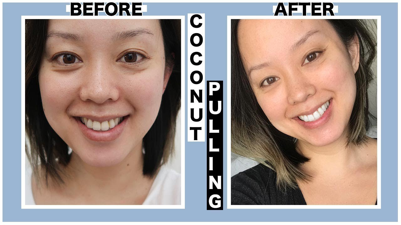 Brushing Teeth With Coconut Oil Wholesale Dealer, Save 56% | jlcatj.gob.mx