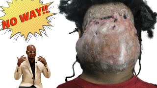 19 Year Massive Acne Keloidalis Nuchae - AKN Bump Terminated | Dr U is Dr Bumpinator