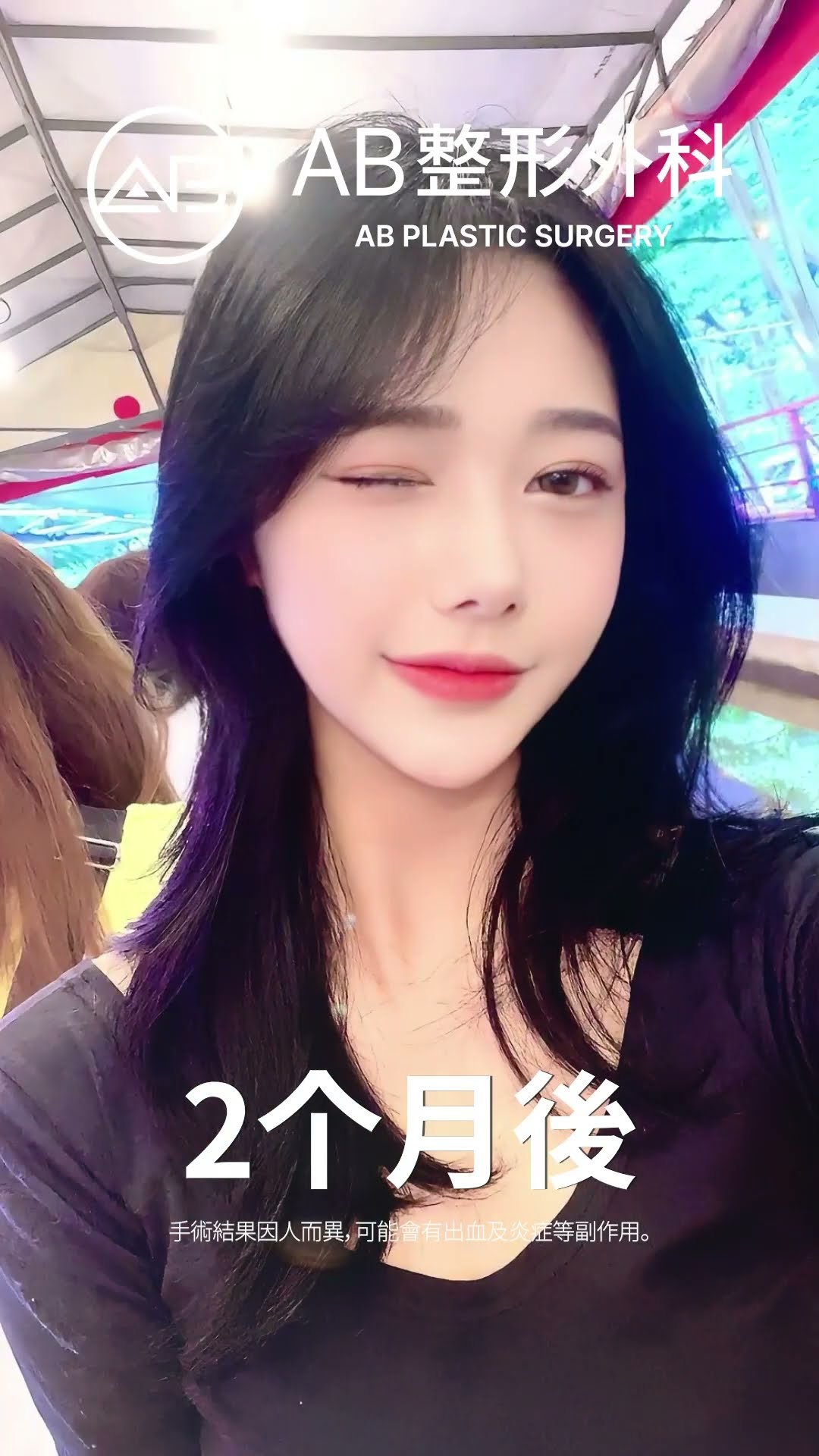 蛻變重生：眼部與輪廓整形的驚艷成果 #热门 #推荐