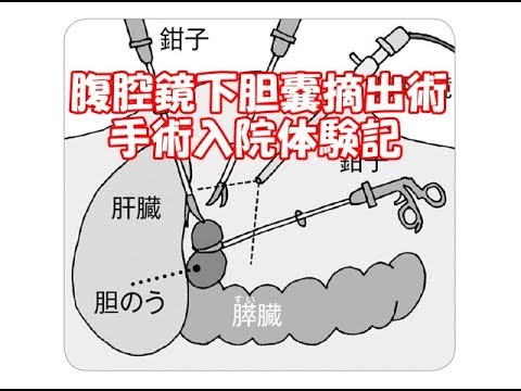 腹腔鏡下胆嚢摘出術 手術入院2日目 手術当日 手術前 手術前後の注意点 YouTube