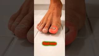 What Is An Ingrown Toenail 3d animation