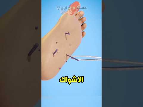 لماذا لا يجب نزع أشواك قنفذ البحر بسرعة