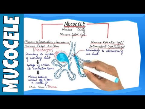 Mucocele - Types, Clinical Features, Histopathalogic features & Treatment