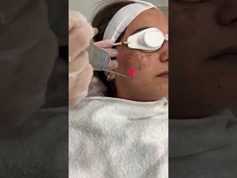 Q-Switched Laser Toning (pigmentation removal)