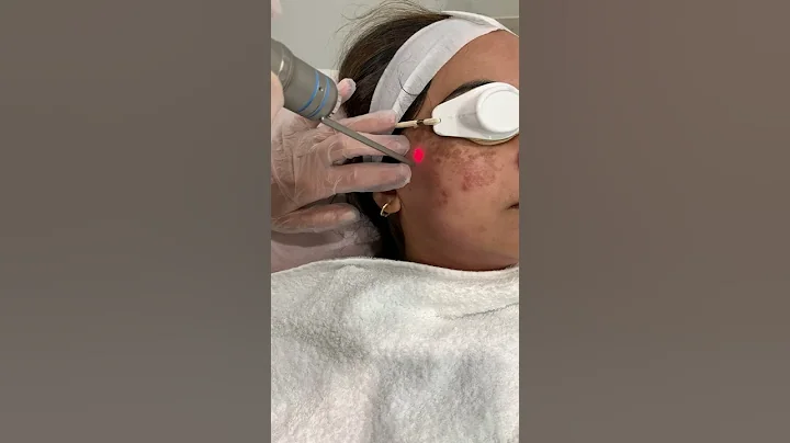 Q-Switched Laser Toning (pigmentation removal) - DayDayNews