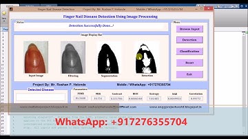 Matlab Code for Fingernail Disease Detection using Image Processing