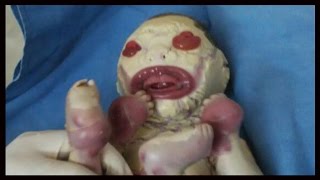 Baby Born With No Skin In India (And Other Unusual Babies)