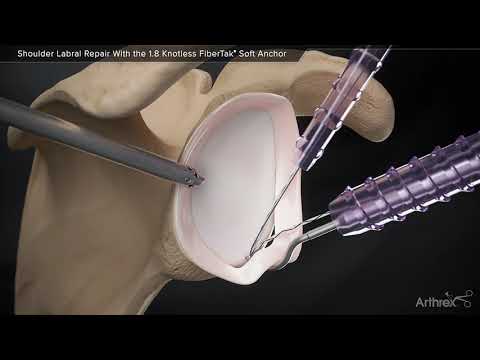visco articulația umărului plus tehnica de administrare unguent pentru traume și dureri articulare