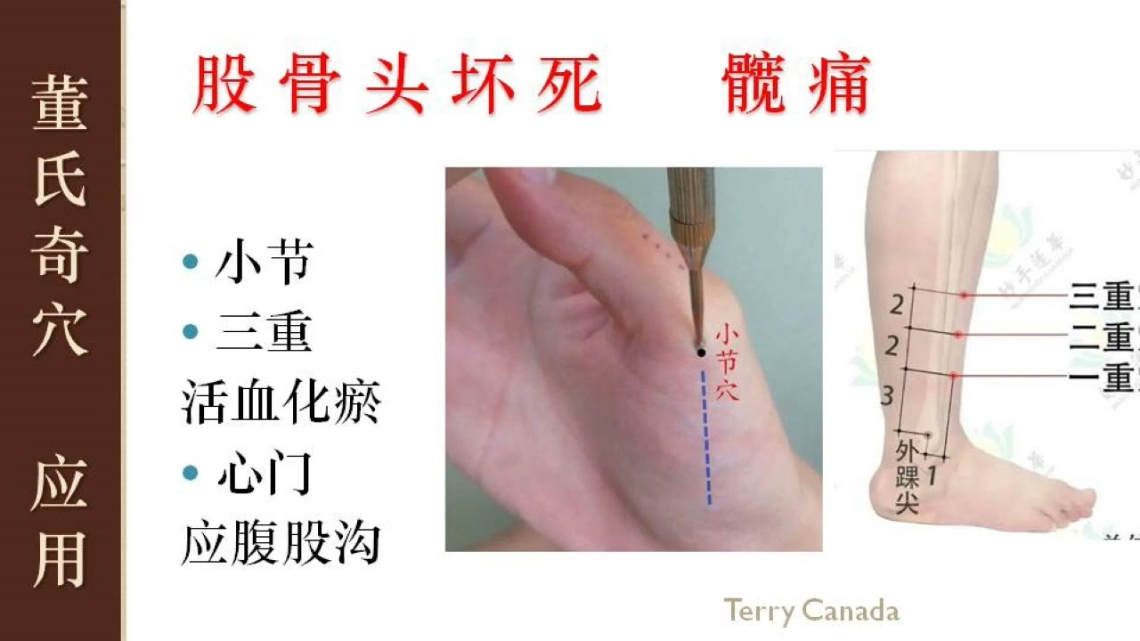 6 13 股骨头坏死小节 三重 董氏奇穴 林君 Master Tung Acupuncture Points Youtube