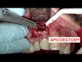 APICOECTOMY ROOT END DENTAL SURGERY. Questions? -818.776.0055