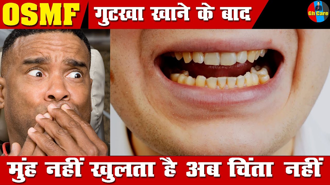 Mouth Cancer Treatment Oral Cancer गुटखा खाने के बाद मुंह नहीं