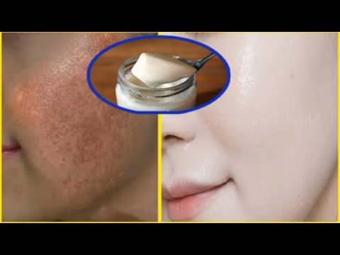 Nám da, đốm đen chi chít cũng hết sạch, nhờ phương pháp đơn giản này (Treatment of melasma)