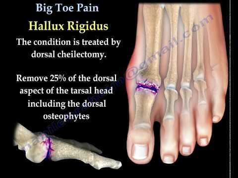 Video: MTP Joint: Toe And Foot Pain