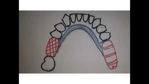 Path of Insertion and Guide Planes in Removable partial dentures