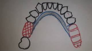 Path of Insertion and Guide Planes in Removable partial dentures