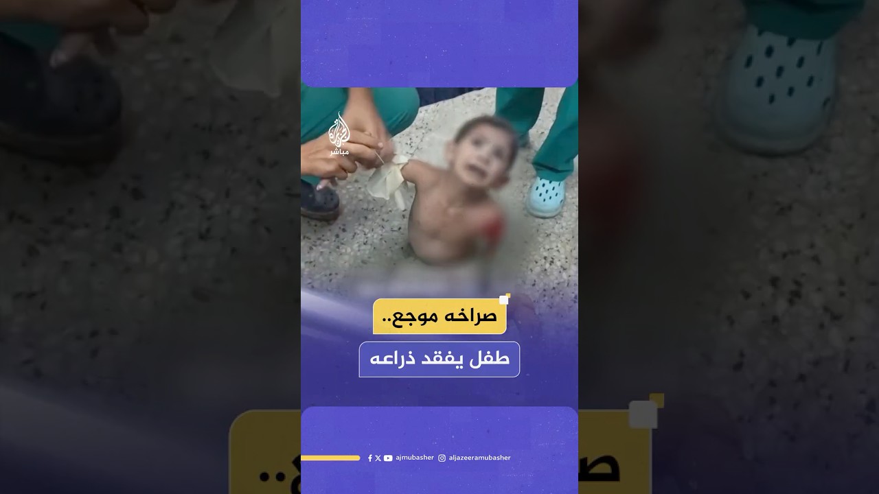 طفل غزي يفقد ذراعه جراء قـصـ ـف إسرائيلي على مدرسة القاهرة التي تؤوي عددا من العائلات النازحة