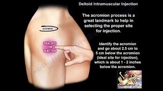 Deltoid Injection - Everything You Need To Know - Dr. Nabil Ebraheim