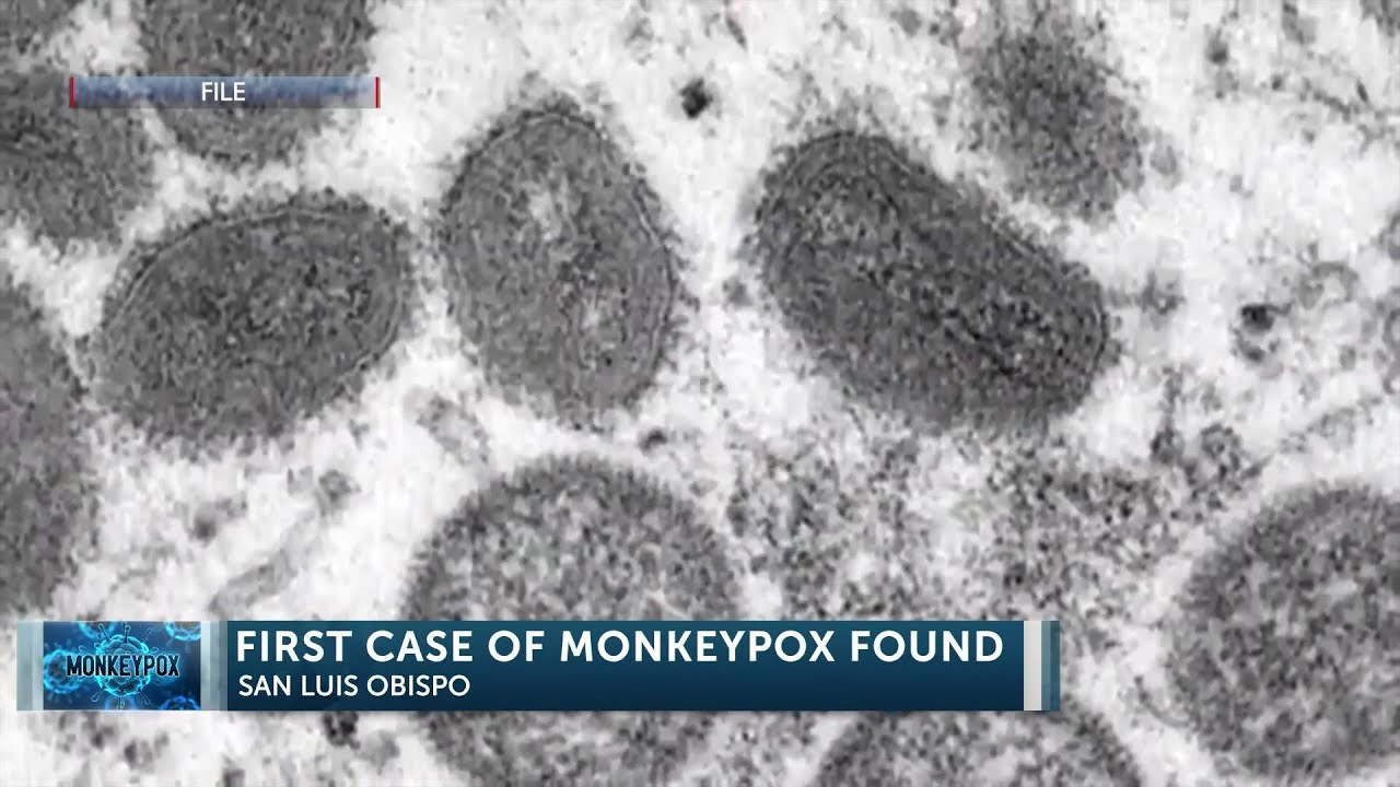 San Luis Obispo County Public Health confirms first case of Monkeypox ...