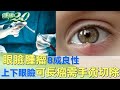 眼瞼腫瘤8成良性 上下眼瞼皆可長瘤需手術切除 健康2.0 @tvbshealth20