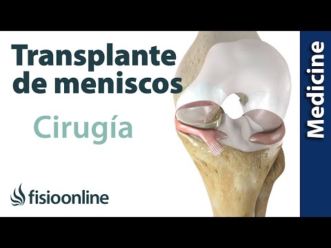 CIRUGÍA de TRASPLANTE de MENISCO