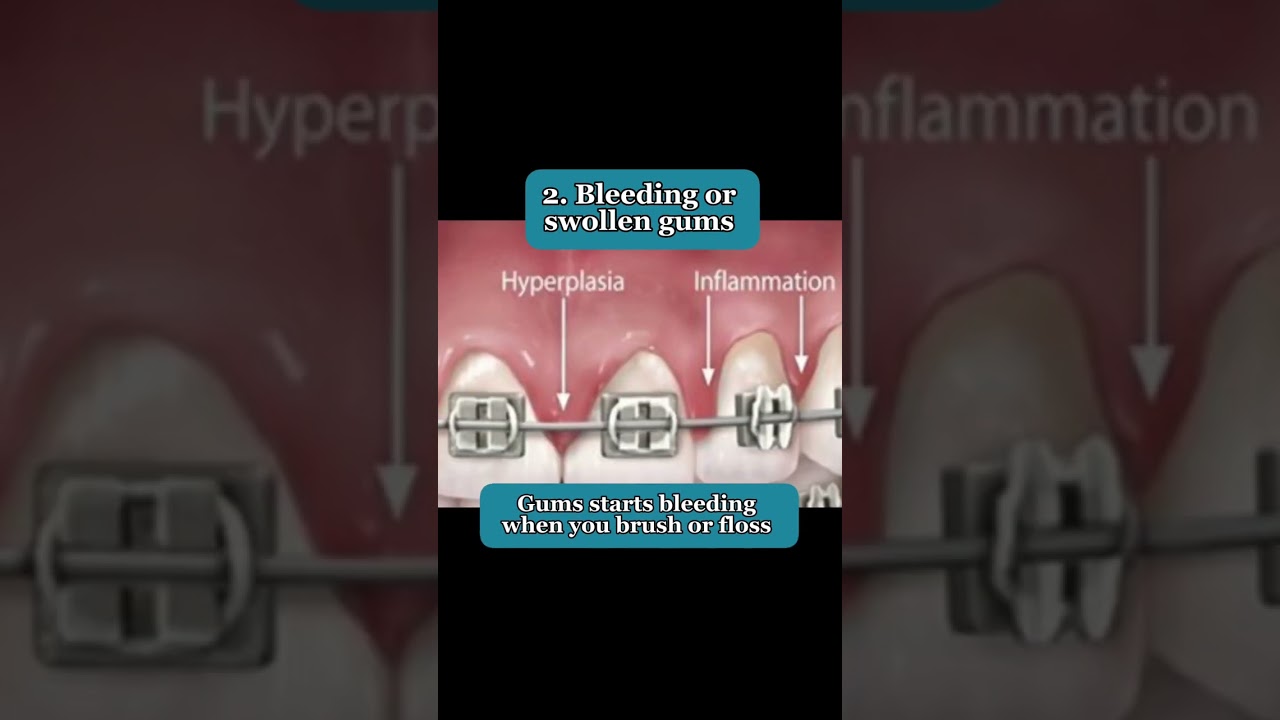 Gum Recession with Braces👀
