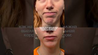 Тгк: Честный Косметолог | Инст: dr_alishka_ #врачкосметолог #ботокс #botox #ботулинотерапия