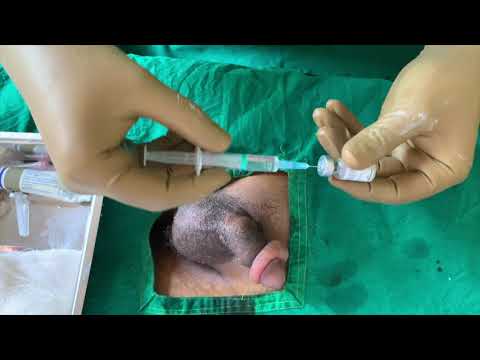 Paraphimosis Management & Reduction Options
