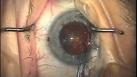 Capsulorhexis technique using "cutting" Utrata forceps