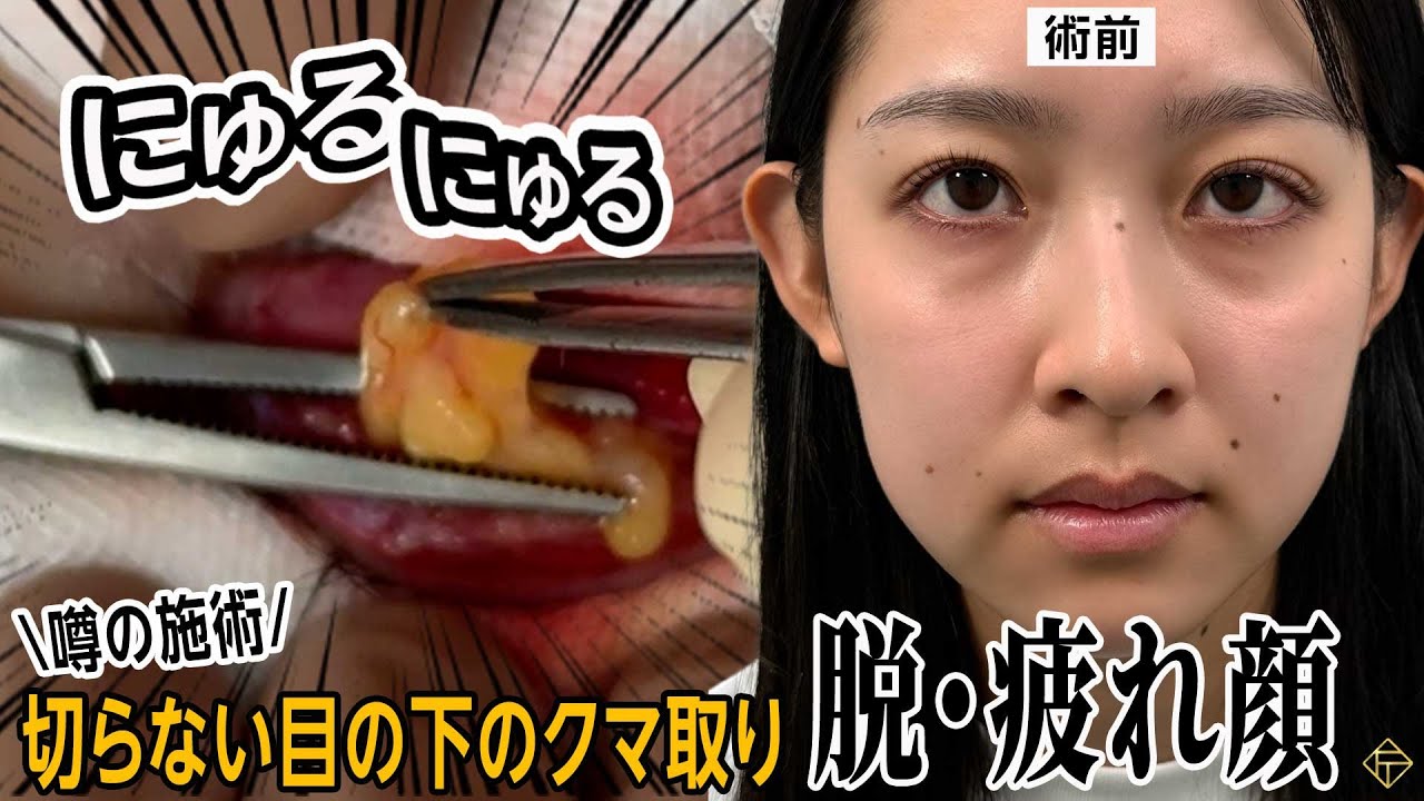 手術動画】疲れ顔から卒業！大人気・切らないクマ取り手術の全貌を公開