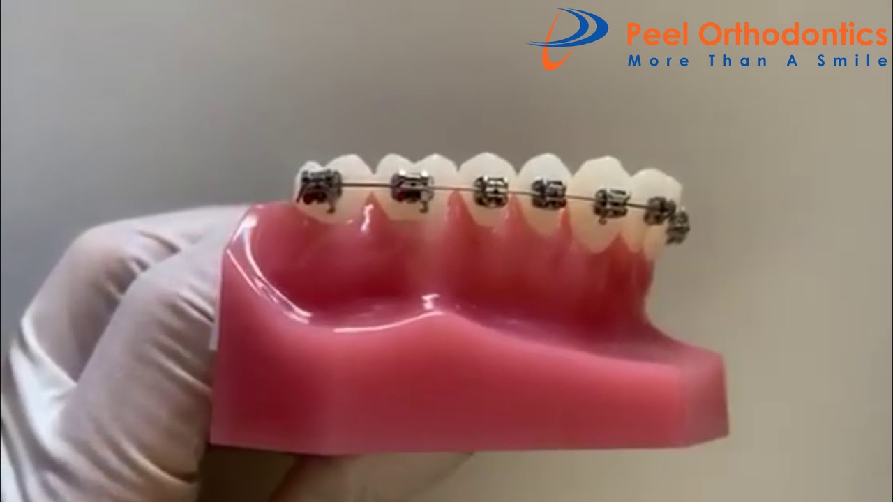 How to fix a moving archwire