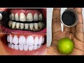 Teeth Whitening at Home in 2 minutes | How to naturally whiten teeth yellow teeth | 100% effective