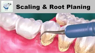 Dental Scaling and Root Planing || Treatment of Gum Disease