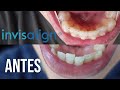 INVISALIGN: EXPERIENCIA, PRECIO Y RESULTADOS