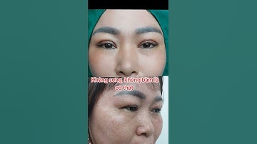 Cắt mí không sưng, không bầm là có thật nha khách.