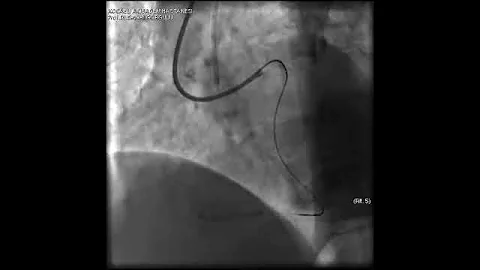 Aortic dissection and radial rupture during retrograde CTO PCI: Management of complications VİDEO 23