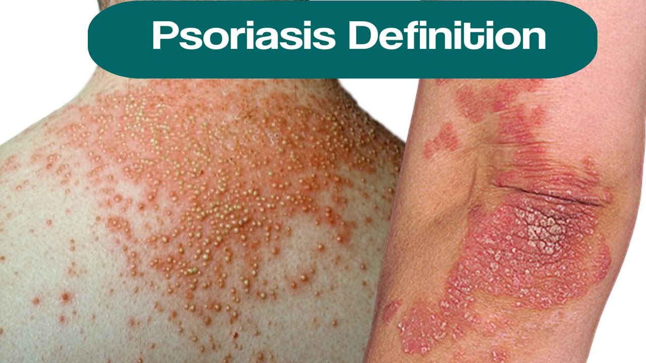 Psoriasis Definition, What Is Plaque Psoriasis, Shampoo For Scalp