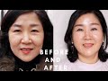 Jina kims moms amazing plastic surgery transformation  seoul guide medical