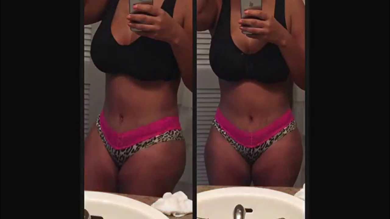 2 weeks Tummy Tuck post op NO MORE DRAINS! YouTube