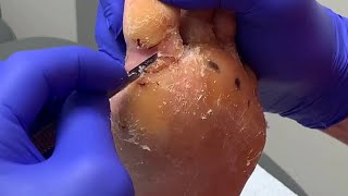 Corn Removal with Callus Over Year Old - Removing Hard Foot Callus - Foot Care Podiatry