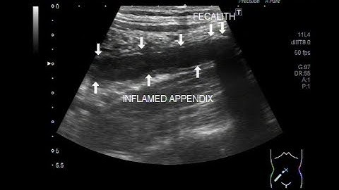 Ultrasound Video showing an inflamed appendix with a fecalith in it.