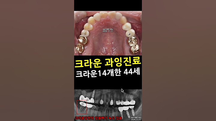 크라운 과잉진료. 44세에 크라운 14개한 환자. 생활치크라운 대부분 과잉진료. 과잉진료없는치과. 씹을때 아프면 교합조정 해야지, 크라운하고 자빠짐 크라운14강 2025_02_04