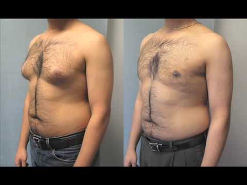 On Gynecomastia Patients From Miami Orlando And Palm Beach Florida