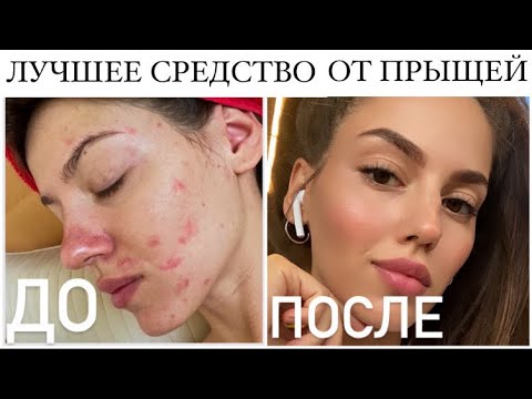 Видео: Работает ли Proactiv и правильно ли это для ваших прыщей?