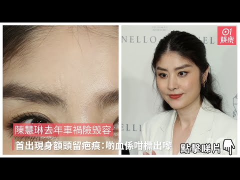 陳慧琳去年車禍險毁容　首出現身額頭留疤痕：啲血係咁標出嚟｜01娛樂