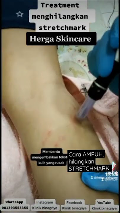 CARA CEPAT MENGHILANGKAN STRETCHMARK. HASIL  PERMANEN!!