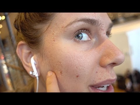 🎅🏻 Lil' Acne